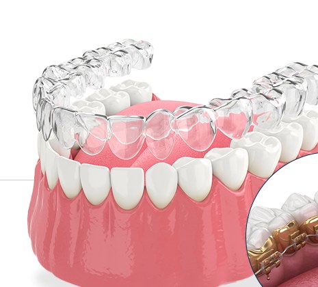 Illustration of an Invisalign clear aligner over a dental model, with an inset showing lingual braces on the inner tooth surfaces