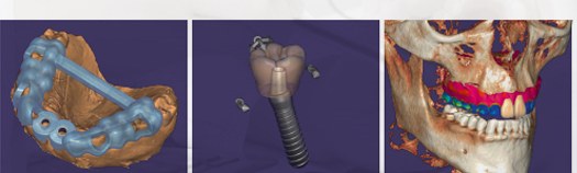 Digital implant guide system: 3D-printed surgical guide, planned implant and 3D CT skull model