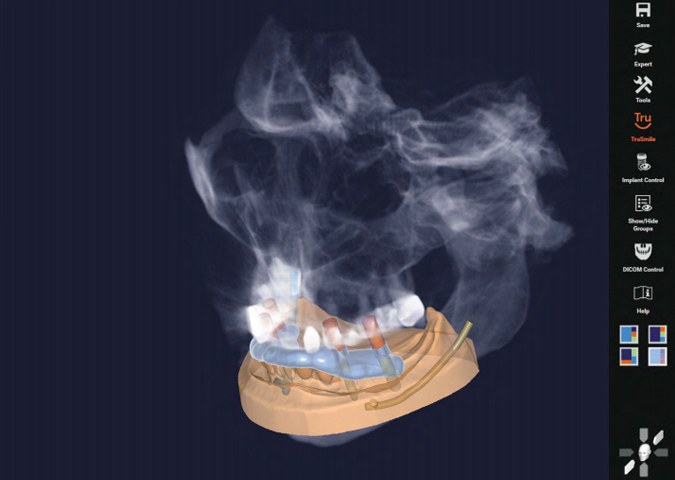 Implant planning software showing the virtual guide on a 3D jaw model