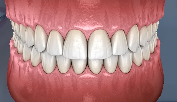 3D illustration of well-aligned front teeth after aesthetic treatment