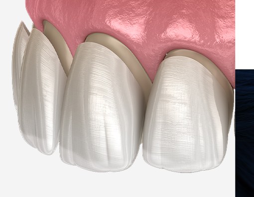 3D illustration of thin E-Max laminates placed over the front teeth