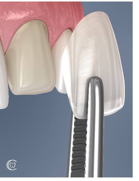 3D illustration of a laminate veneer being placed on a front tooth with tweezers