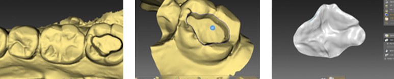 Digital design of a one-day inlay: scanned arch, prepared tooth and designed inlay