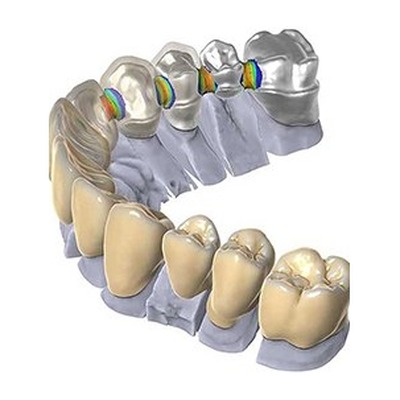 exocad dental CAD crown design