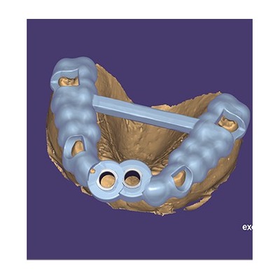 exoplan digital implant guide design